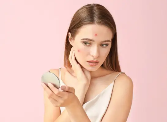 milk cause acne